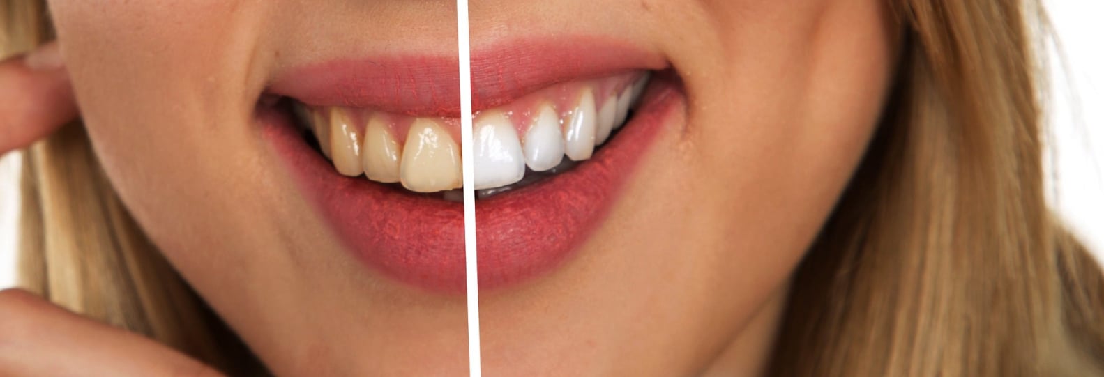 Cosmetic Dentist Wirral